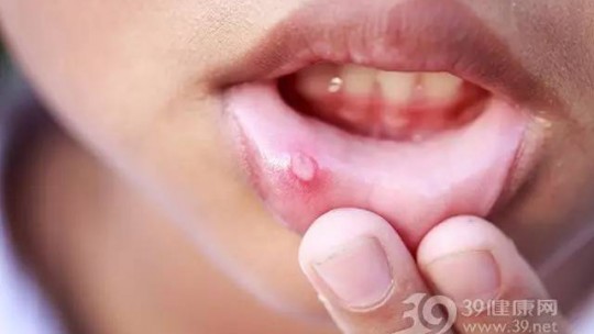 冬季“干燥上火”導(dǎo)致口腔潰瘍？四個(gè)細(xì)節(jié)要注意